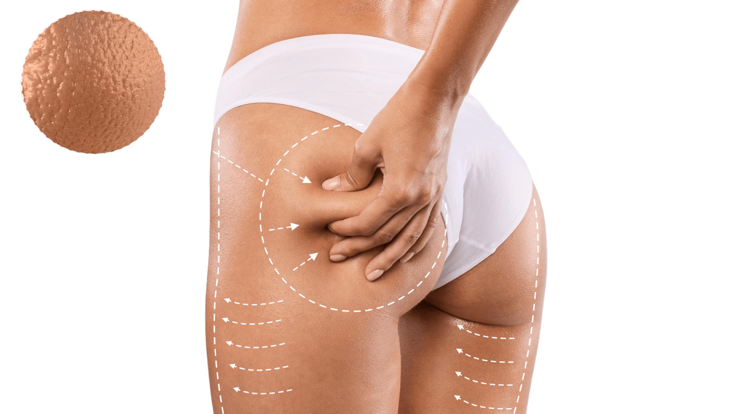 Cellulite treatment13