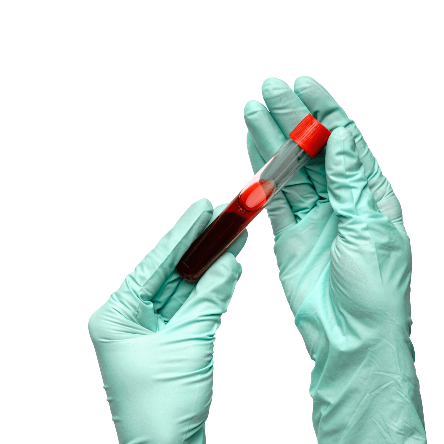 Platelet-rich plasma therapy 8